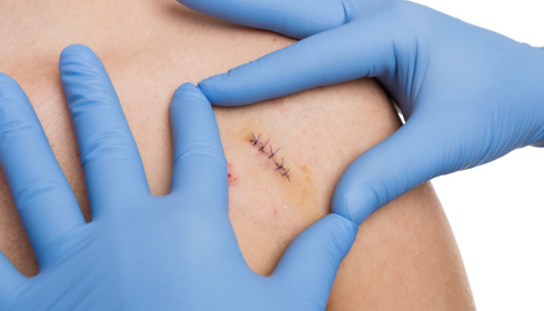 Basic Wound Care at Home Cleaning, Covering and When to Seek Stitches