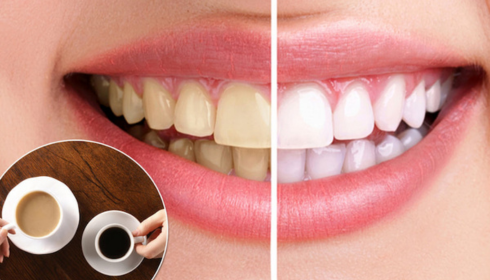Teeth Staining from Tea and Coffee Daily Habits That Reduce Yellowing