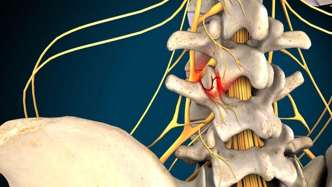 Spondylosis Treatment
